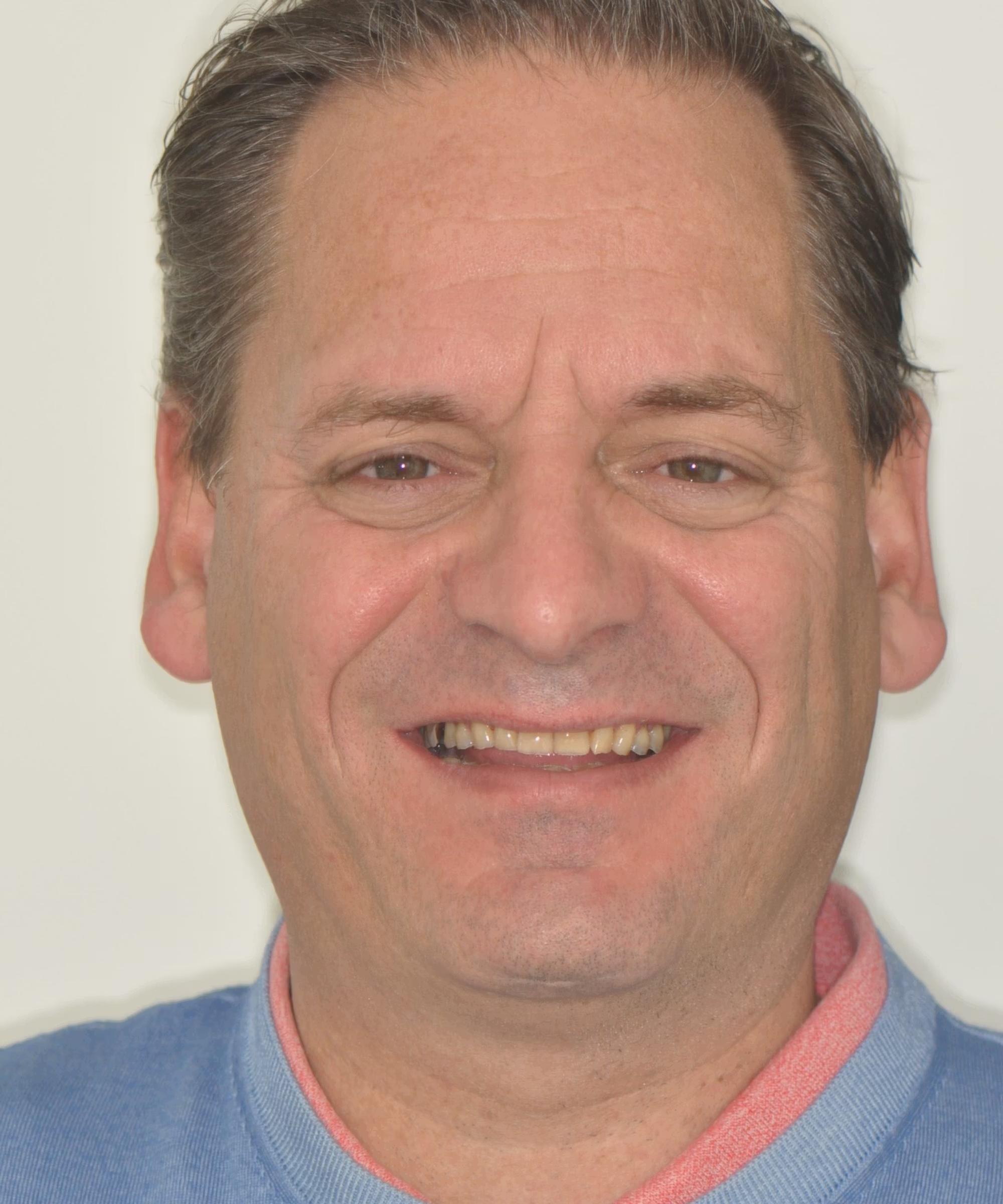 Before facings Huizen