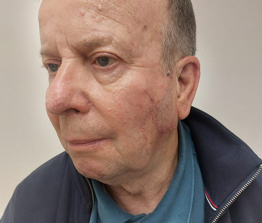 Skin tumour excision and reconstruction, after