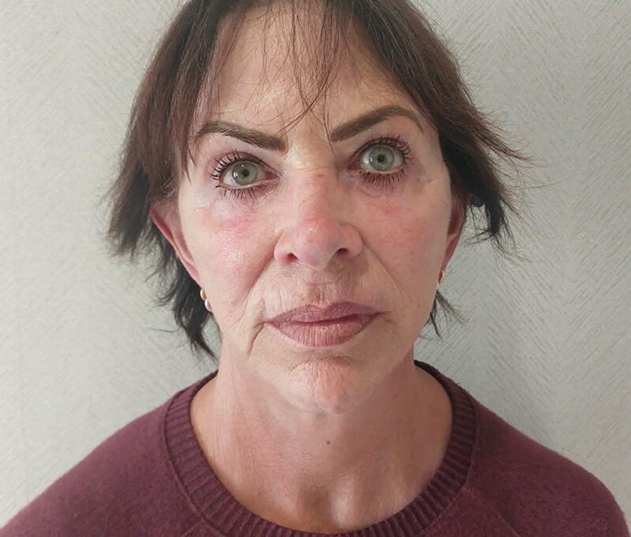 Face and Neck Lift · Patient one, after