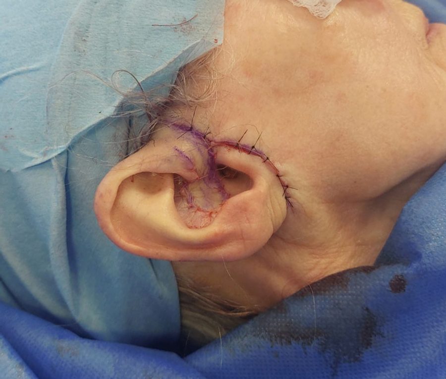 Skin tumour excision and reconstruction · Ear · Shown during surgery and after, after