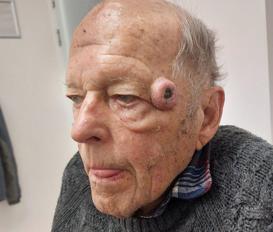 Skin tumour excision with bilateral upper blepharoplasty, before
