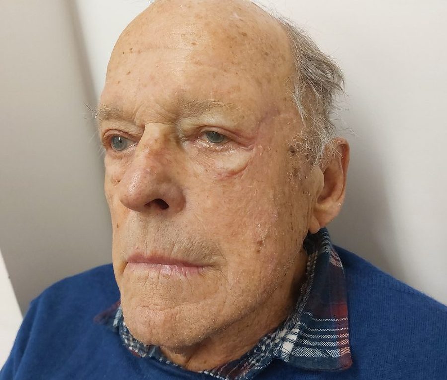 Skin tumour excision with bilateral upper blepharoplasty, after