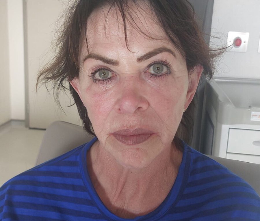 Face and Neck Lift · Patient one, before