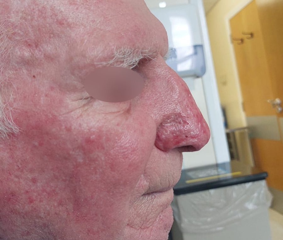 Nose contouring · Patient two, after