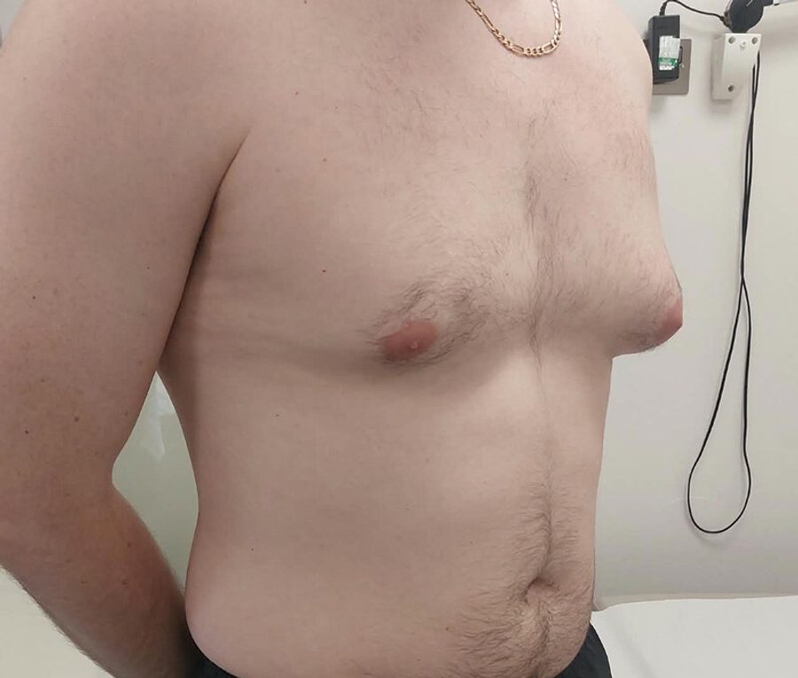 Gynaecomastia Reduction · Patient one · Oblique, before