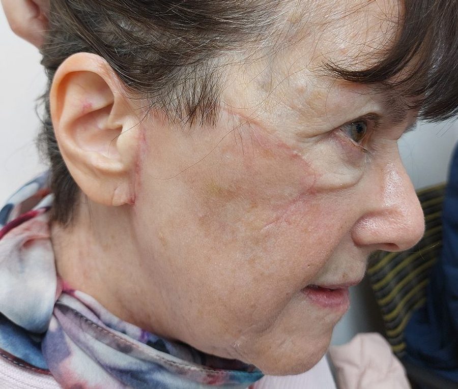 Cheek tumour excision and reconstruction, after