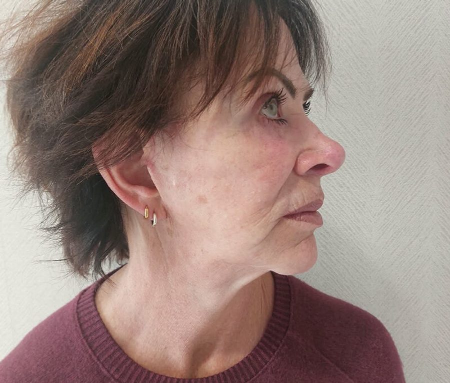Face and Neck Lift · Patient one · Right 3/4, after
