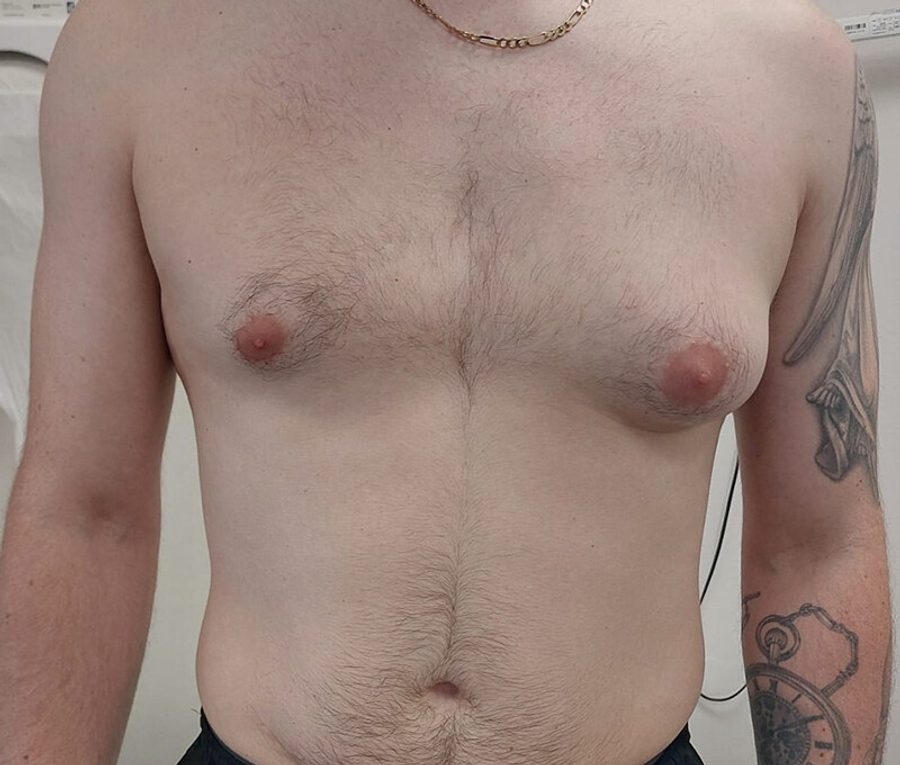 Gynaecomastia Reduction · Patient one, before