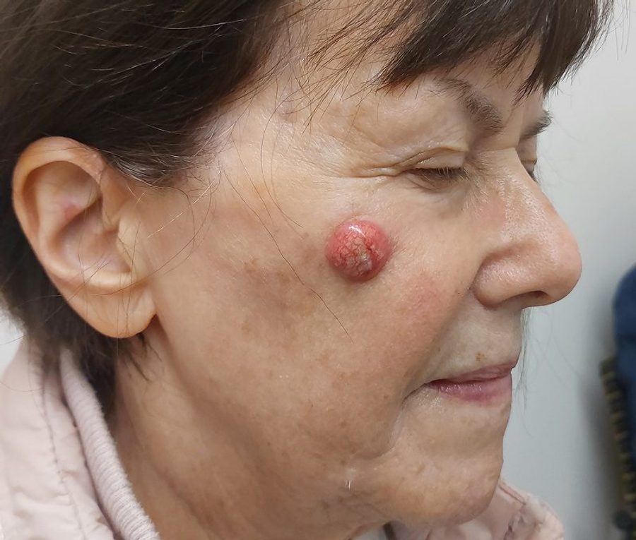 Cheek tumour excision and reconstruction, before