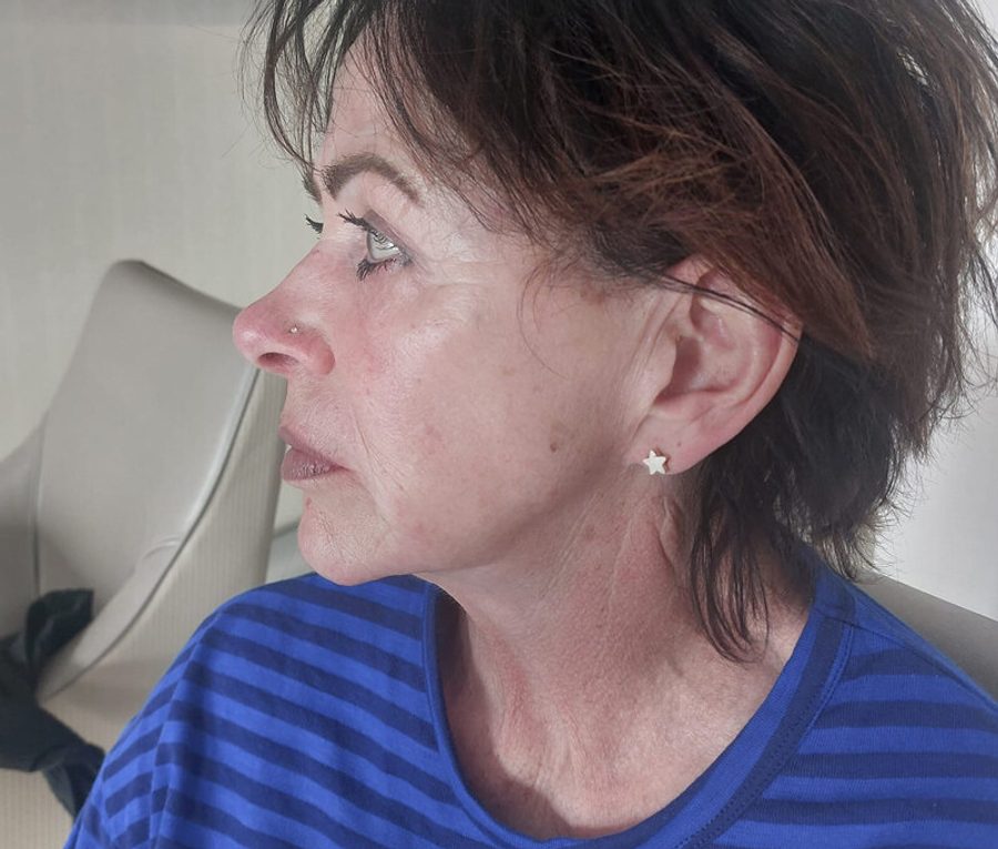 Face and Neck Lift · Patient one · Left profile, before