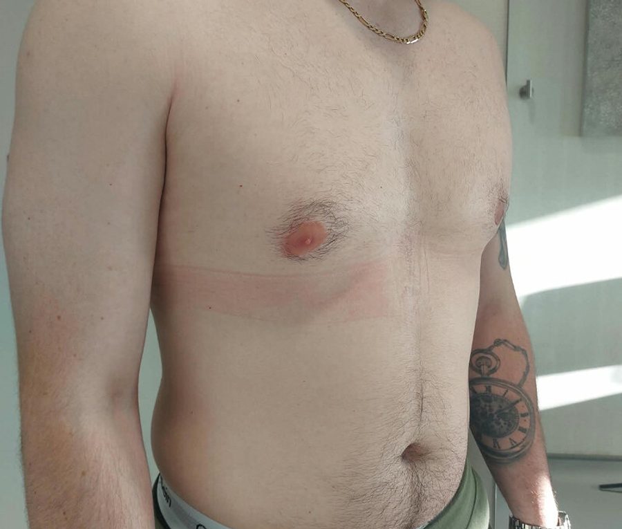 Gynaecomastia Reduction · Patient one · Oblique, after