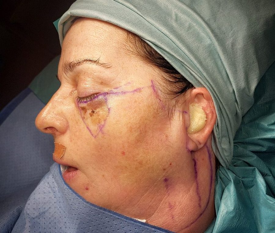 Cervicofacial flap reconstruction · Shown during surgery and healed, before