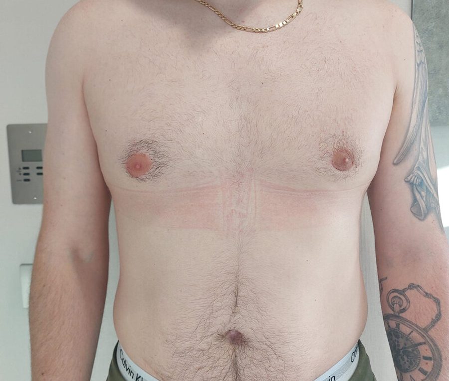 Gynaecomastia Reduction · Patient one, after