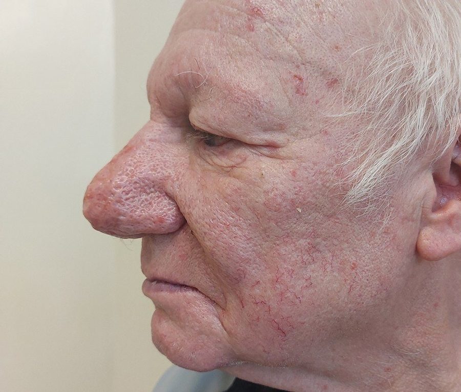 Nose contouring · Patient three · Left profile, after