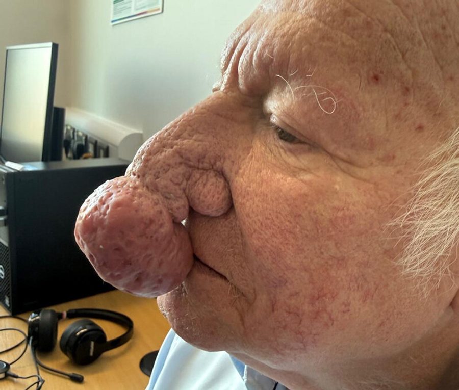 Nose contouring · Patient three · Left profile, before
