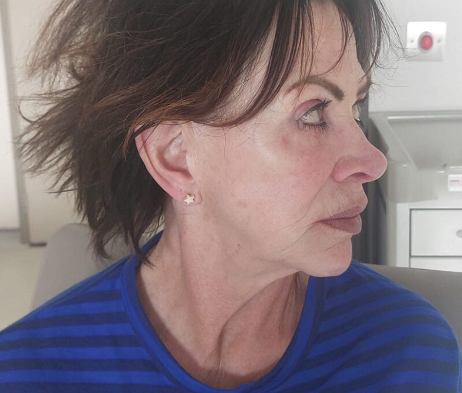 Face and Neck Lift · Patient one · Right 3/4, before