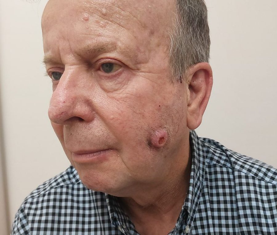 Skin tumour excision and reconstruction, before