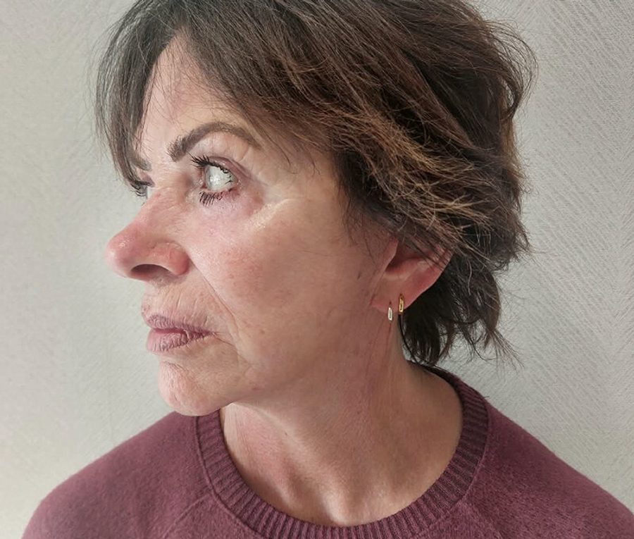 Face and Neck Lift · Patient one · Left profile, after