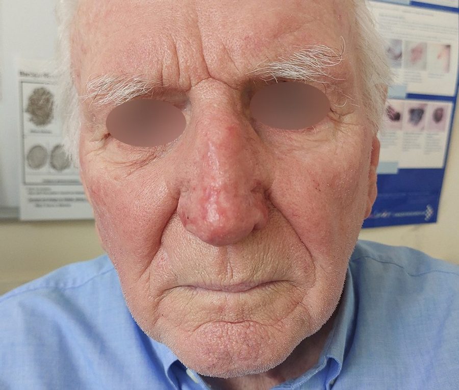 Nose contouring · Patient one, after