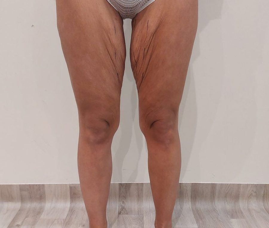 Bilateral thigh reduction, before