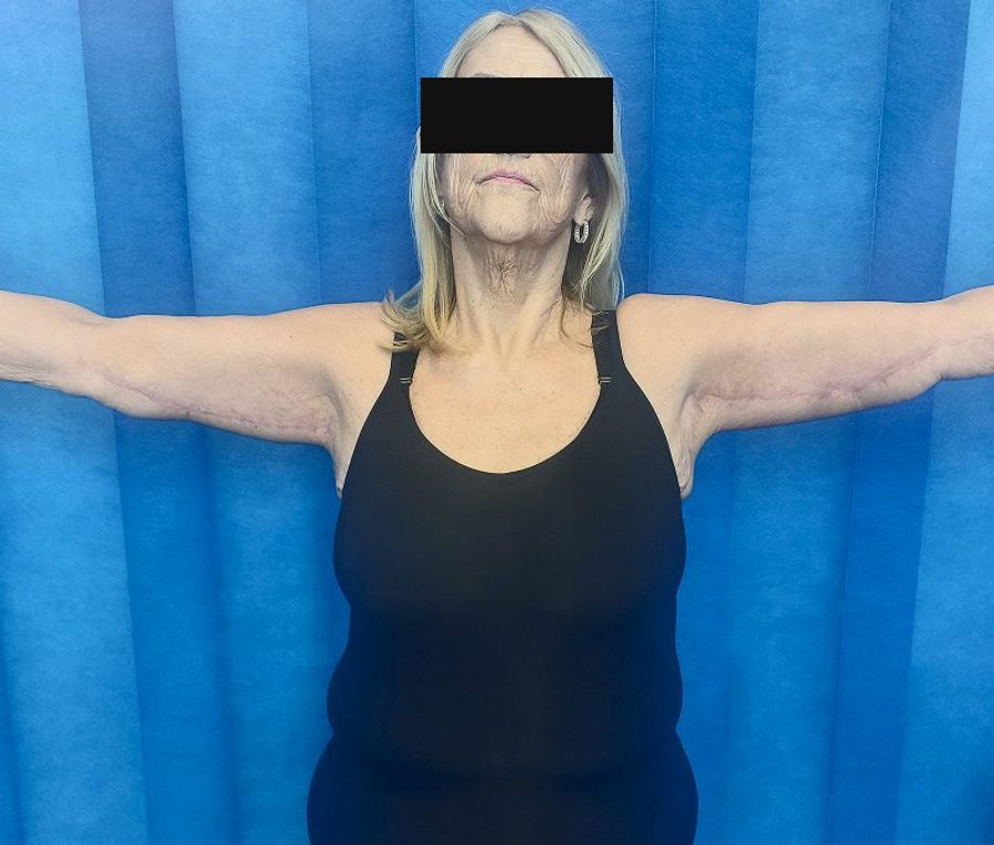 Bilateral arm reduction, after
