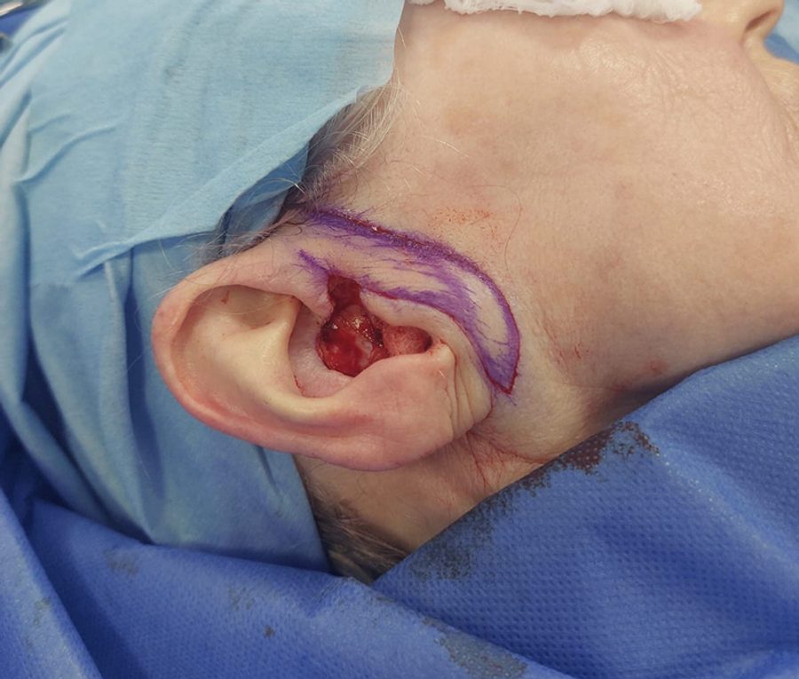 Skin tumour excision and reconstruction · Ear · Shown during surgery and after, before