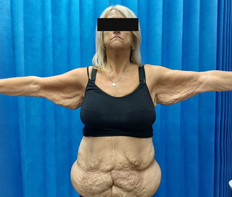 Bilateral arm reduction, before