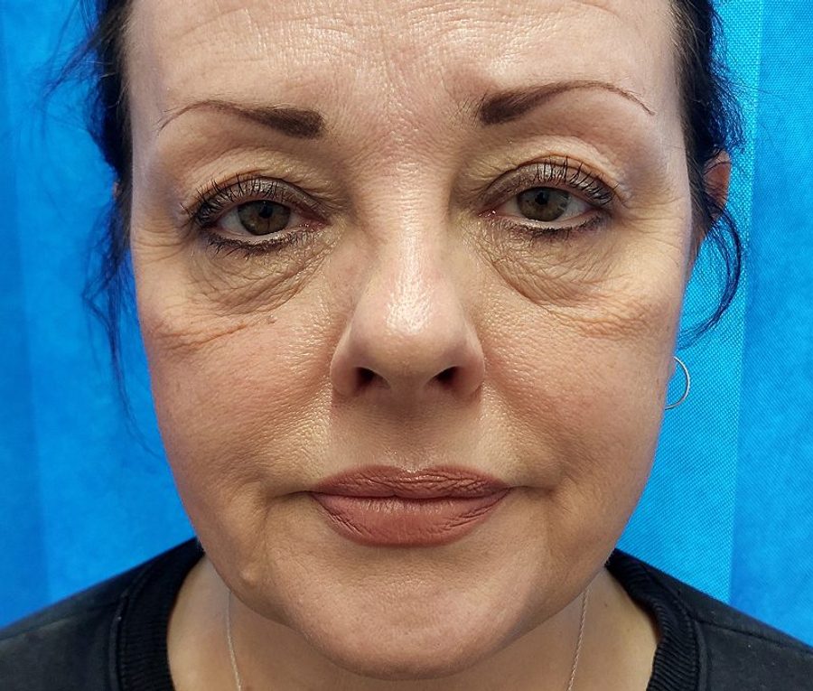 Upper and lower lid blepharoplasty, before