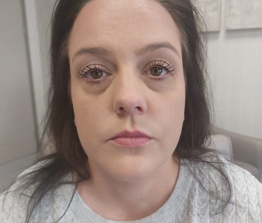 Lower lid blepharoplasty, before