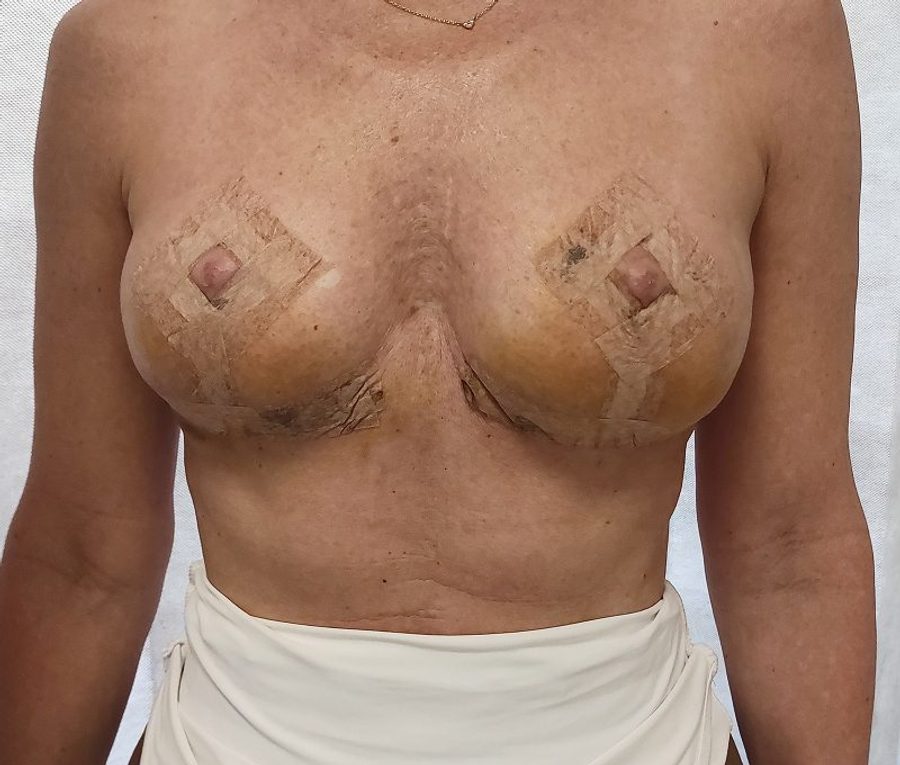 Bilateral explant with mastopexy · One week after surgery, after