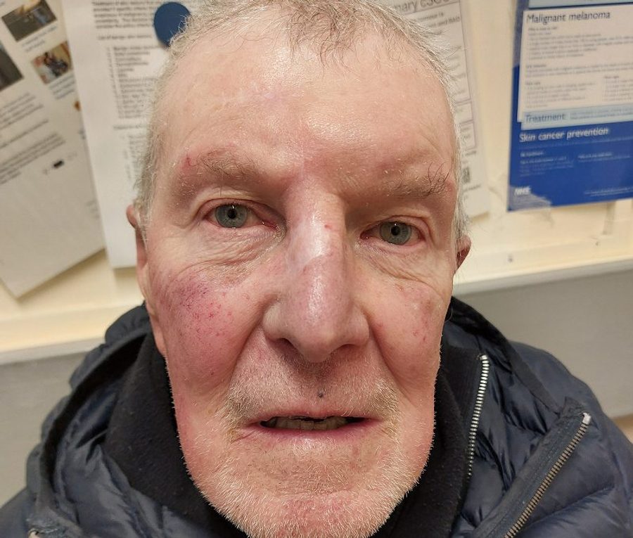 Forehead flap reconstruction, after