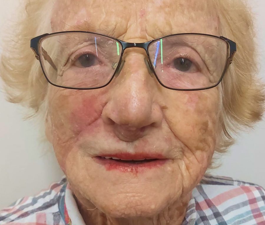 Nasolabial flap reconstruction, after