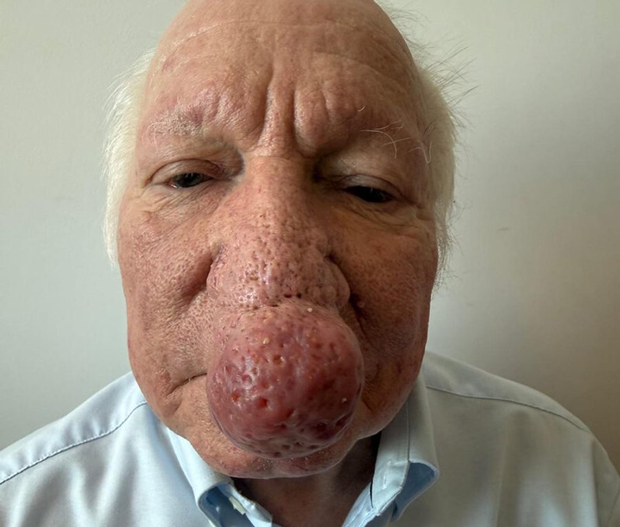 Nose contouring · Patient three, before