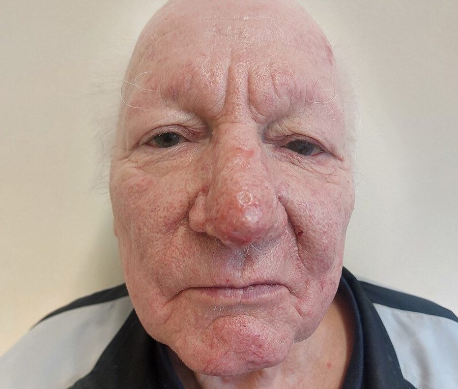 Nose contouring · Patient three, after