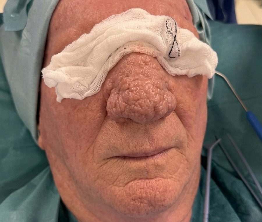 Nose contouring · Patient one, before