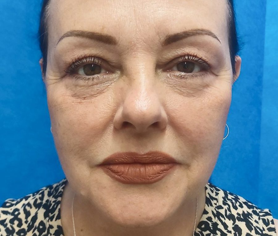Upper and lower lid blepharoplasty, after