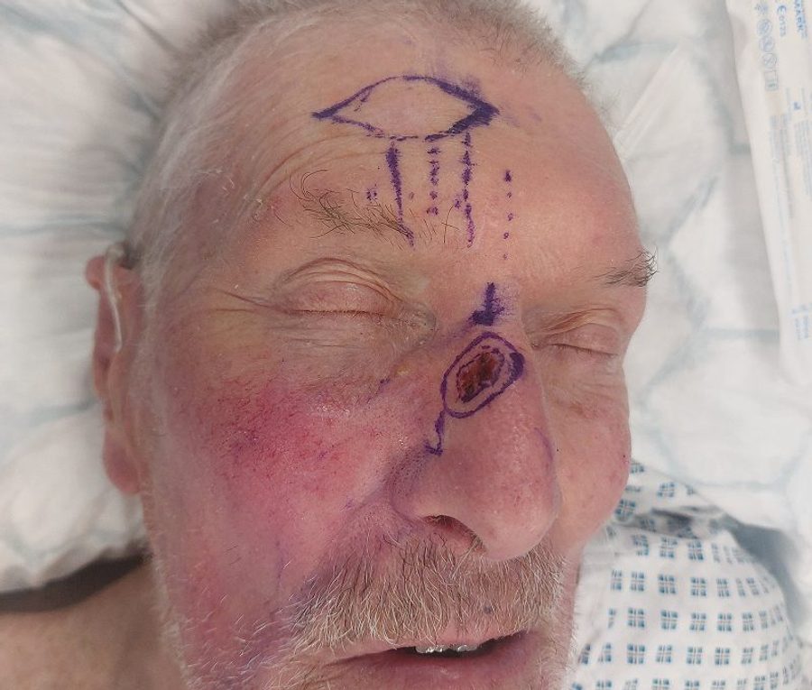 Forehead flap reconstruction, before