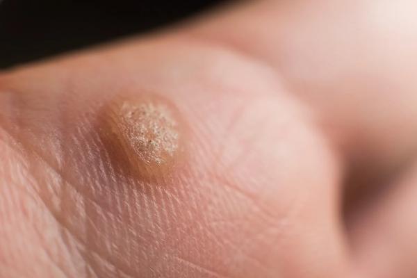 Warts and Verrucas: Effective Treatment Options With Platinum Online Pharmacy