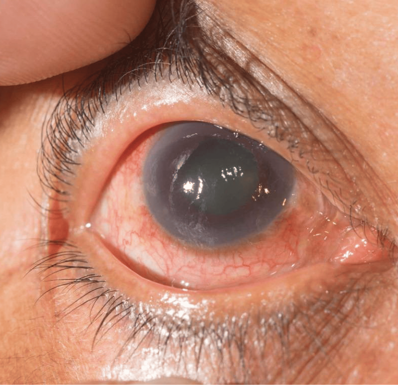 Glaucoma: The Silent Thief of Sight