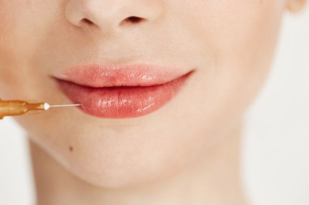 Lip injection with hyaluronic acid