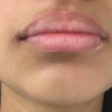 pink pigmentation on lips