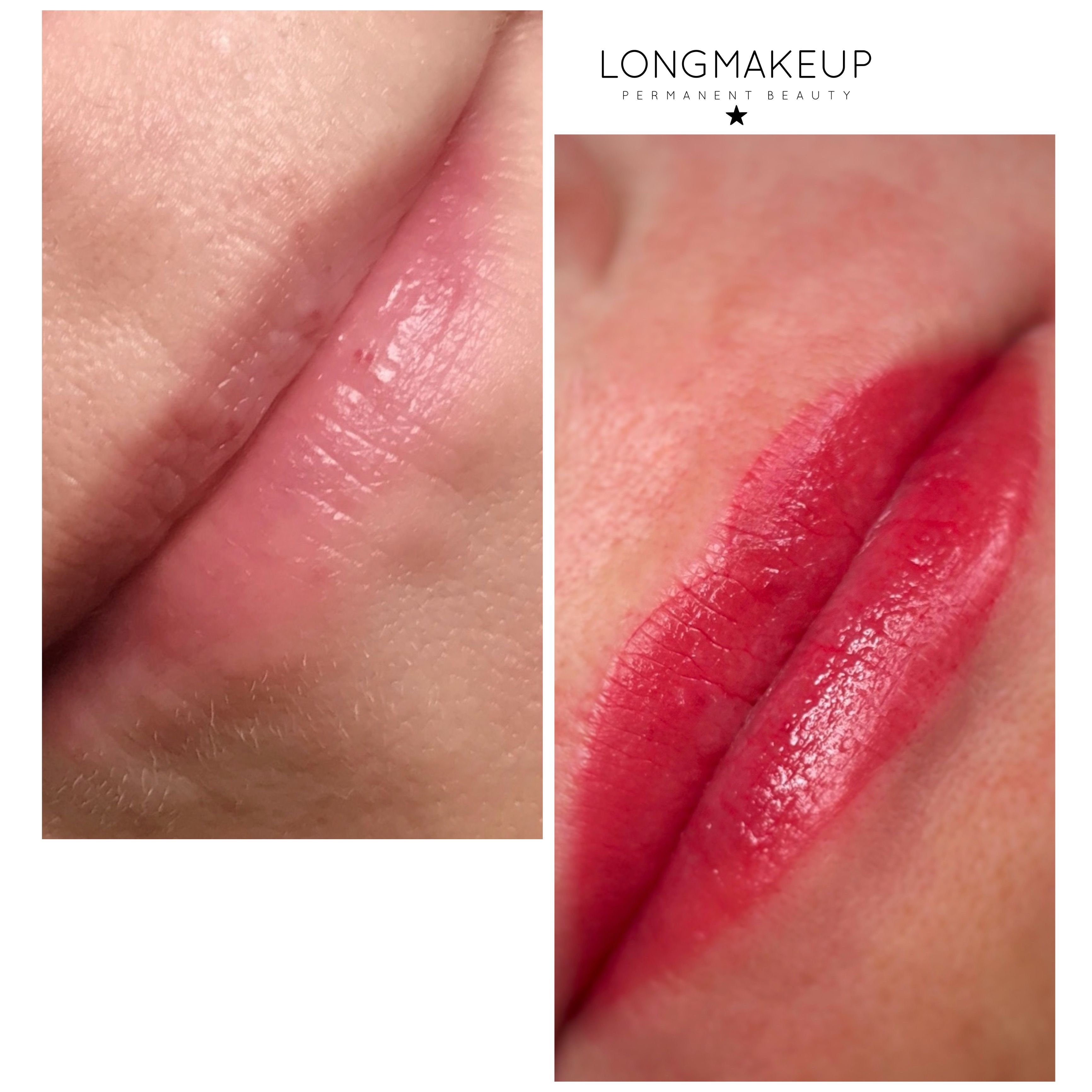 Before after lip contour