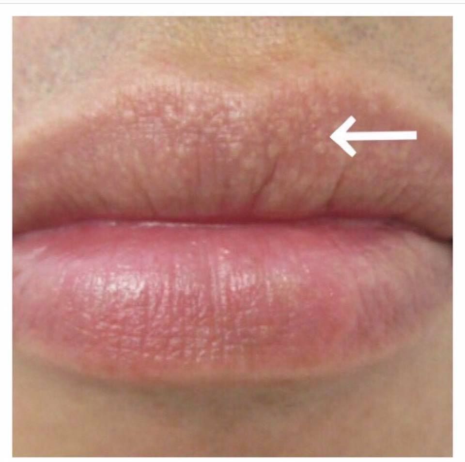 Fordyce spots on lips