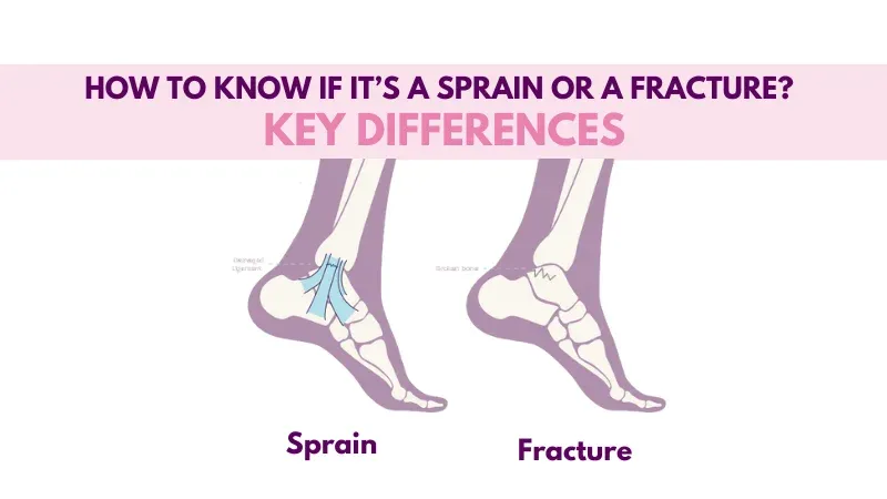 Know If It’s a Sprain