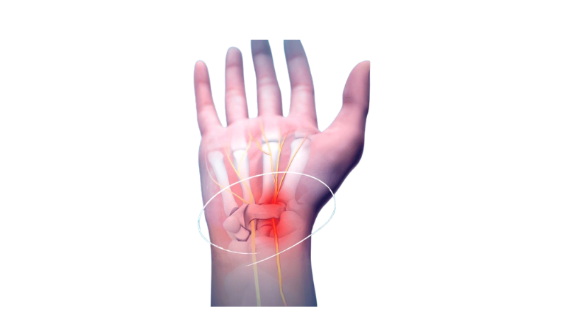 Carpal Tunnel Syndrome Treatment