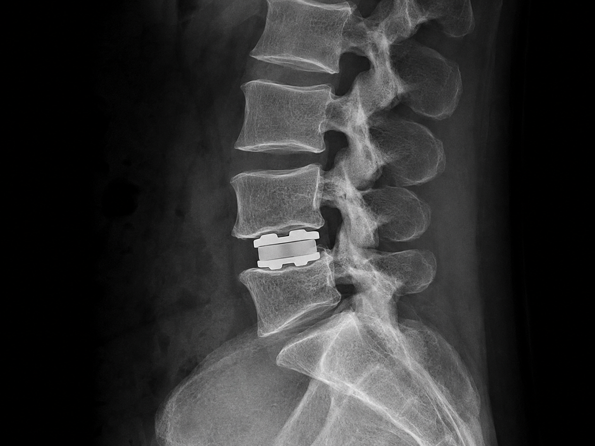 Lumbar Disc Replacement