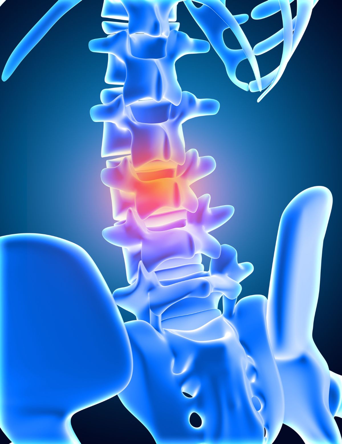 Laminectomy