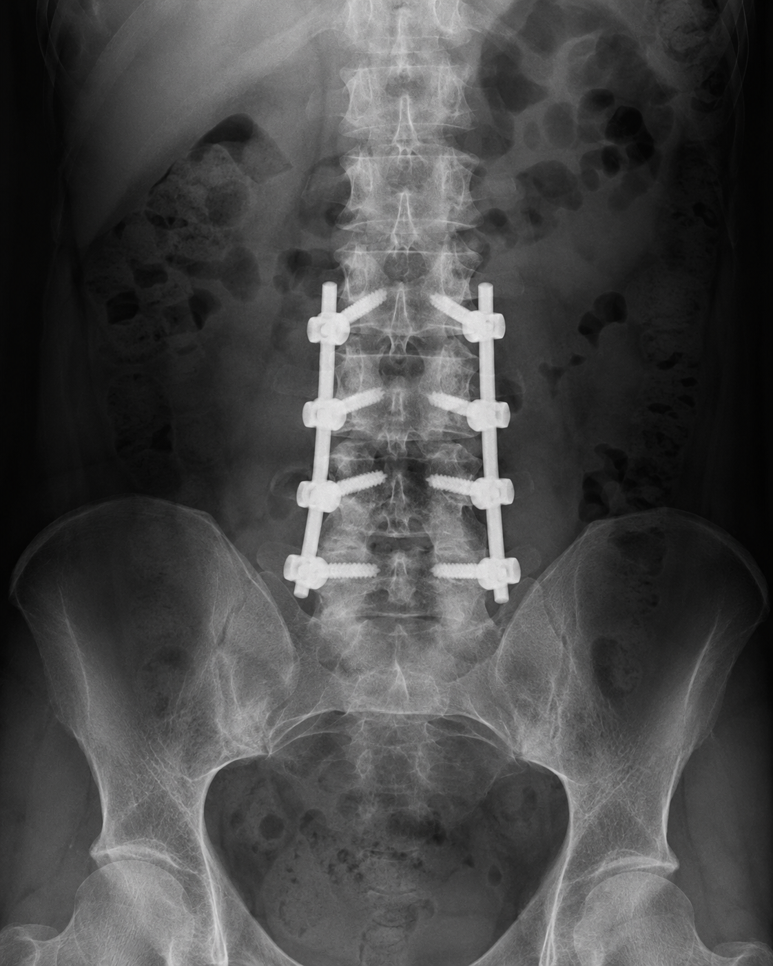 Lumbar Fusion
