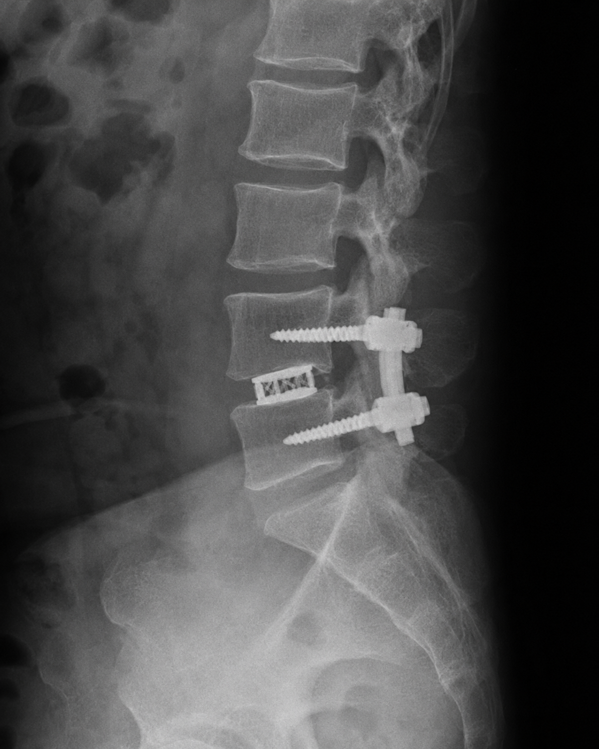 Transforaminal Lumbar Interbody Fusion