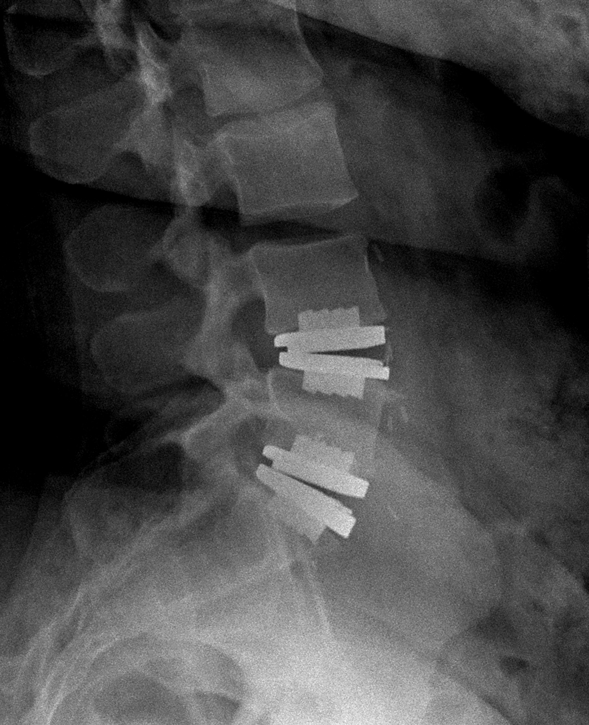 Lumbar Disc Replacement